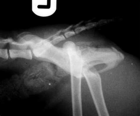 Posterior hip dislocations and posterior wall acetabular fractures, like the injury suffered by alabama quarterback tua tagovailoa, are rare injuries in football. Open reduction and placement of an iliofemoral anchor ...