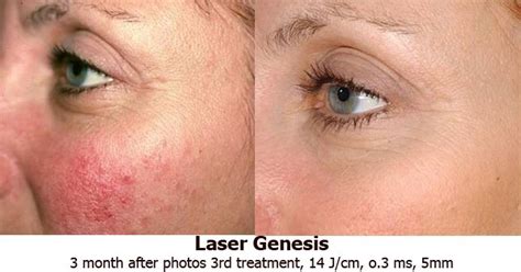 Before And After Laser Genesis Rosacea Redness Dandruff Treatment