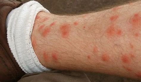 Spots On The Legs Itch Causes Methods Of Treatment Prevention