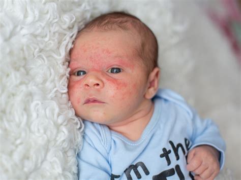 How To Tell If Your Baby Has Eczema Or Infant Acne Balmonds