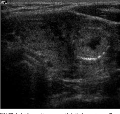 Sonography Of Thyroid Nodules With Peripheral Calcifications