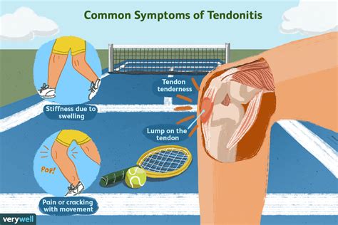 Tendonitis Symptoms Causes And Treatments