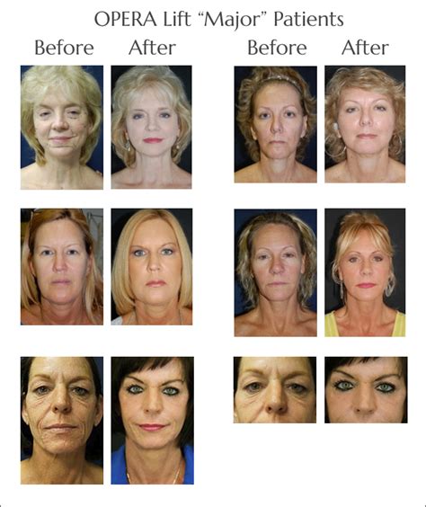 Non Surgical Face Lift In Jacksonville The Operalift At By Lewis J Obi
