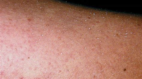 Alpha Hydroxy Lotion Keratosis Pilaris Beauty Skin Bumps Skin
