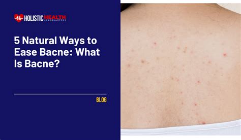 Banish Bacne Naturally 5 Effective Ways To Ease Back Acne