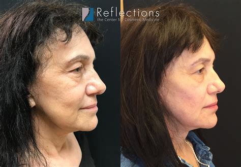 non surgical face lift for woman in her 70 s before and after photos new jersey reflections center