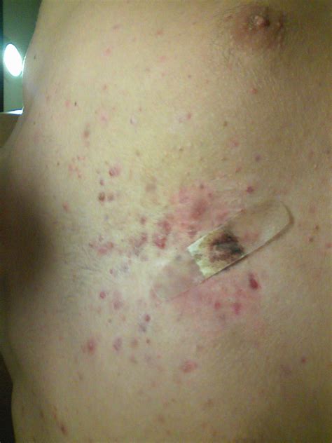 Severe Chest Acne Need Advice Scar Treatments By Chestne Acne