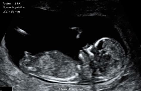 Foetus âgé De 13 Sa 77 Jours De Gestation Anatomie Et Motricité