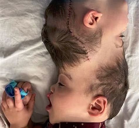 Conjoined Twins Born With Fused Brains Separated After 27 Hours