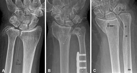 Scielo Brasil Ulnar Shortening Osteotomy Our Experience Ulnar