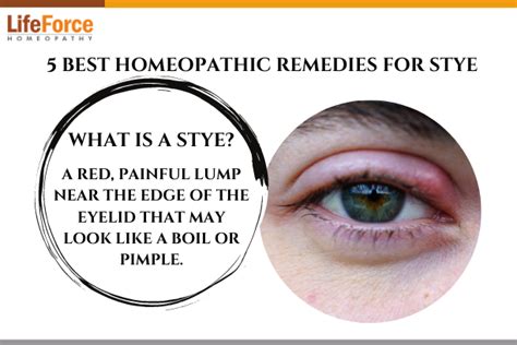 5 best homeopathic remedies for stye