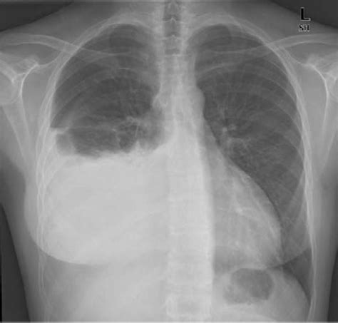 The lungs and the chest cavity both have a lining that consists of pleura, which is a thin membrane. Chest X-ray showing right pleural effusion. | Download ...