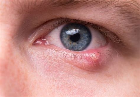 Eye Discharge And Associated Eye Problem Eyemantra