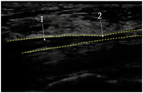 Diagnostics Free Full Text How To Differentiate Pronator Syndrome