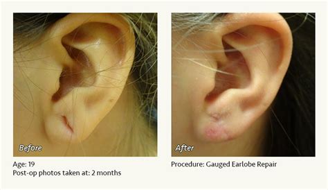 Ear Lobe Surgery Earlobe Repair Or Split Earlobe Surgery Is A Quick