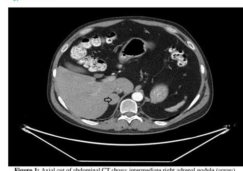 Figure 1 From A Case Report Of Cortisol Secreating Adrenal Adenoma