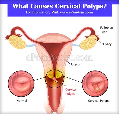 Uterine Polyp As Related To Cervical Polyps Pictures