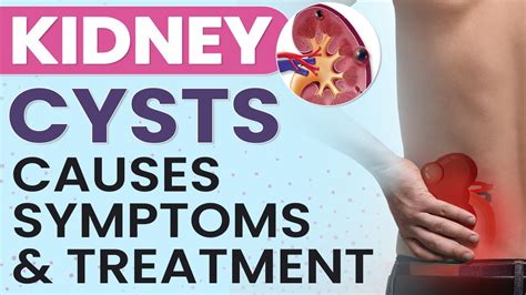 Kidney Cysts Causes Symptoms And Treatment Youtube