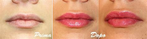 Ecco come prendersi cura di labbra eccessivamente asimmetrice (labbro superiore sottilissimo da ricostruire) per un effetto. FILLER viso e labbra CON ACIDO IALURONICO