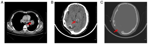 Delayed Pulmonary Metastasis And Recurrence Of Intracranial Malignant