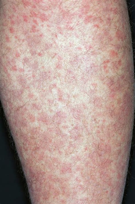 Allergic Purpura On The Leg Photograph By Dr P Marazziscience Photo