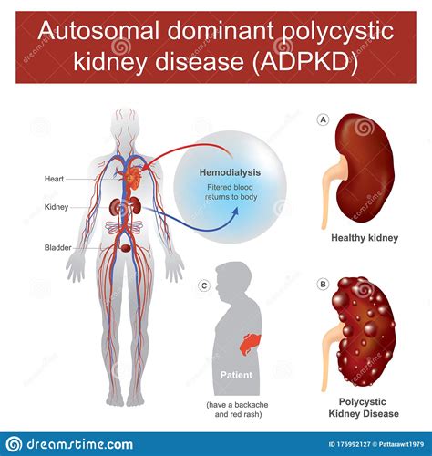 Autosomal Dominant Polycystic Kidney Disease Stock Illustration