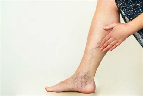 5 Essential Tips For Managing Chronic Venous Insufficiency Treat N Heal