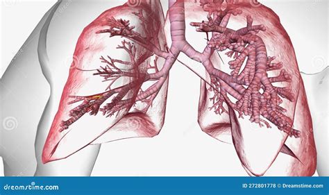 Bronchiectasis Affecting The Lungs Characterized By Inflamed Airways