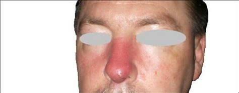 Nasal Cellulitis Causes Symptoms And Treatments