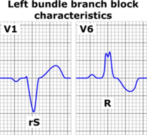 ECGs For EMS Identification Of The Left Bundle Branch Block Part 1