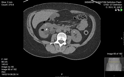 Axial A And B And Coronal C And D Ct Scan Of The Abdomen At The