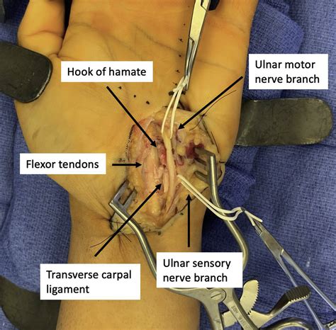 A Modified Surgical Approach Through Guyons Canal And The Proximal