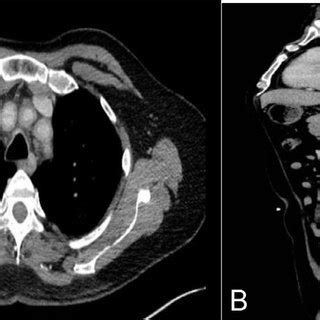 A Contrast Enhanced CT Scan In Axial Section At The Level Of The