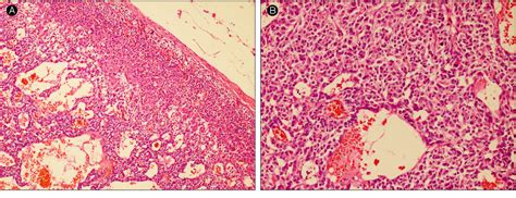 Figure 4 From A Case Of Pheochromocytoma Presenting As Stress Induced