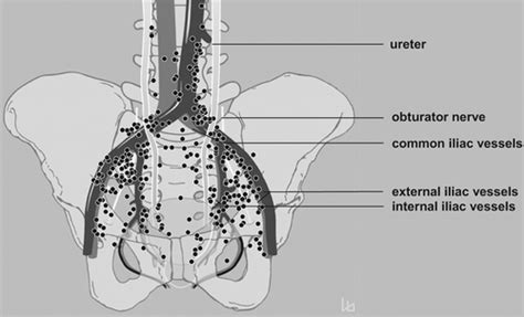 Indications Extent And Benefits Of Pelvic Lymph Node Dissection For