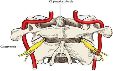 C2 Nerve Dysfunction Associated With C1 Lateral Mass Screw Fixation