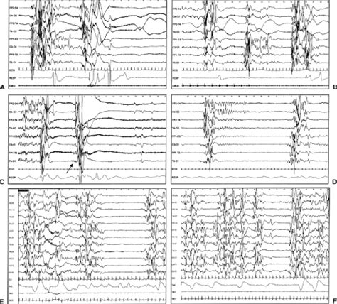 Epilepsy With Myoclonic Absences Neupsy Key