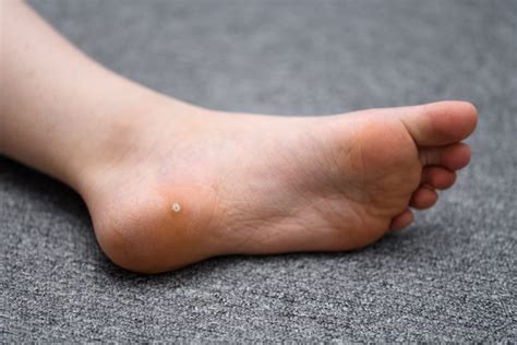Plantar Wart Ideal Foot And Ankle Group