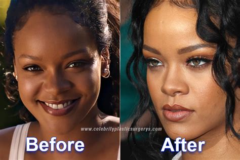 rihanna plastic surgery before and after with pics revealed
