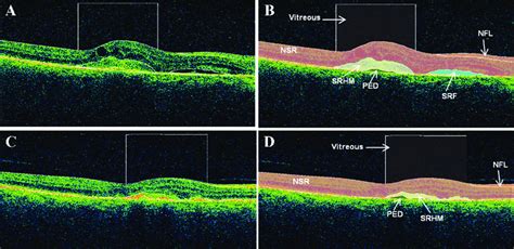 Oct B Scans From An Eye With A Mixed Choroidal Neovascularization Cnv