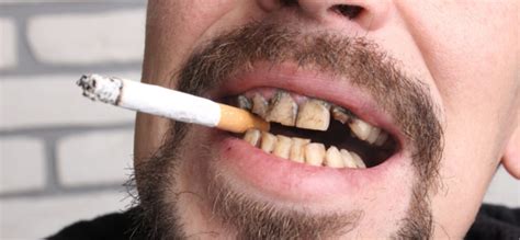 how to remove tobacco stains from your teeth teeth poster