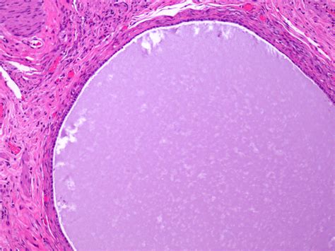 Ovarian Cyst Histology