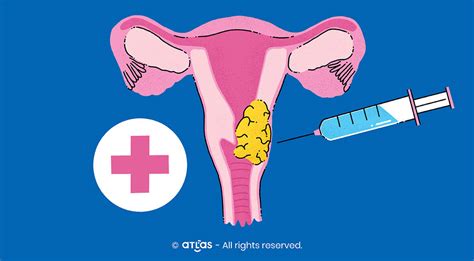 Screening și metode de tratament în cazul cancerului de col uterin ATLAS