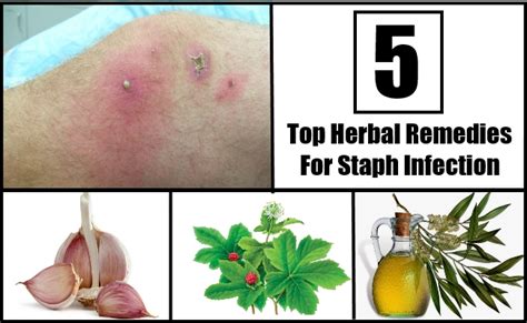 Top 5 Herbal Remedies For Staph Infection Natural Treatments And Cure