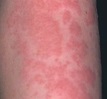 Stress Rash - Pictures, Symptoms, Causes, Treatment