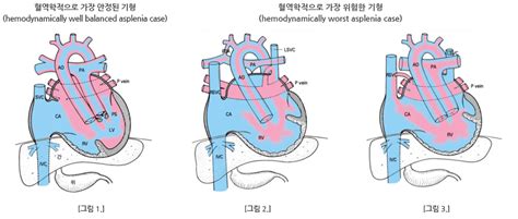 선천성 심장병의 종류 비장증후군 선천성심장병이란 심장질환정보 선천성심장병센터 서울아산병원