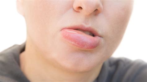 Swollen Bottom Lip Causes For No Reason Treatment Of Lower Lips