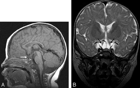 Isolated Absence Of The Optic Chiasm A Rare Cause Of Congenital