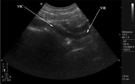 Ultrasound Image Of The Veins Of Pelvis Vic Vena Iliaca Communis