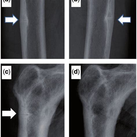 A Looser Zones Of Osteomalacia In A Case Of Tumour Induced